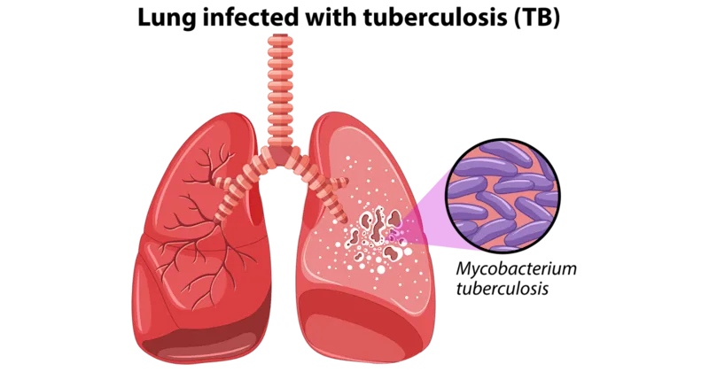 Tuberculosis: Symptoms, Causes, Treatment & Prevention