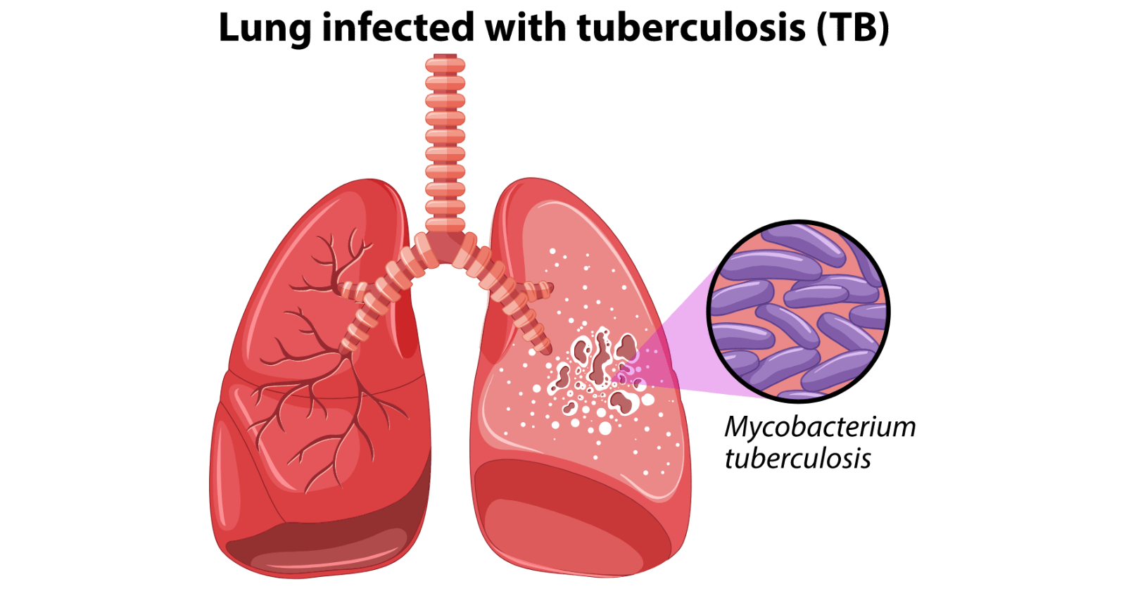 Tuberculosis: Symptoms, Causes, Treatment & Prevention