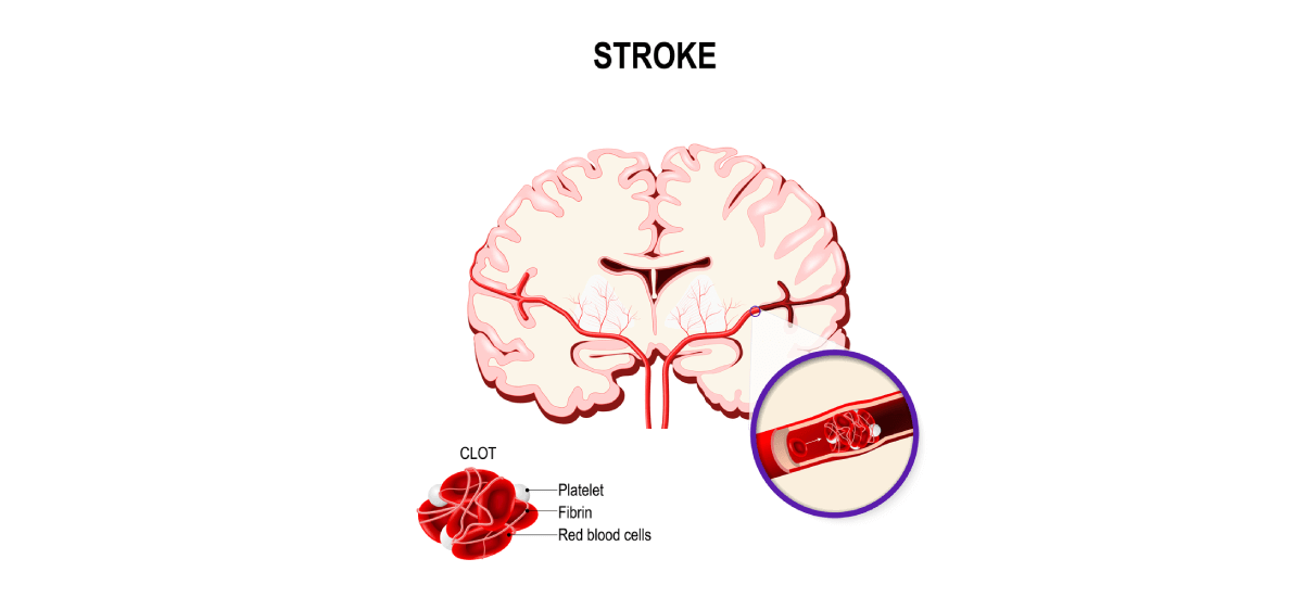 What Causes Stroke? Its Symptoms & Treatments