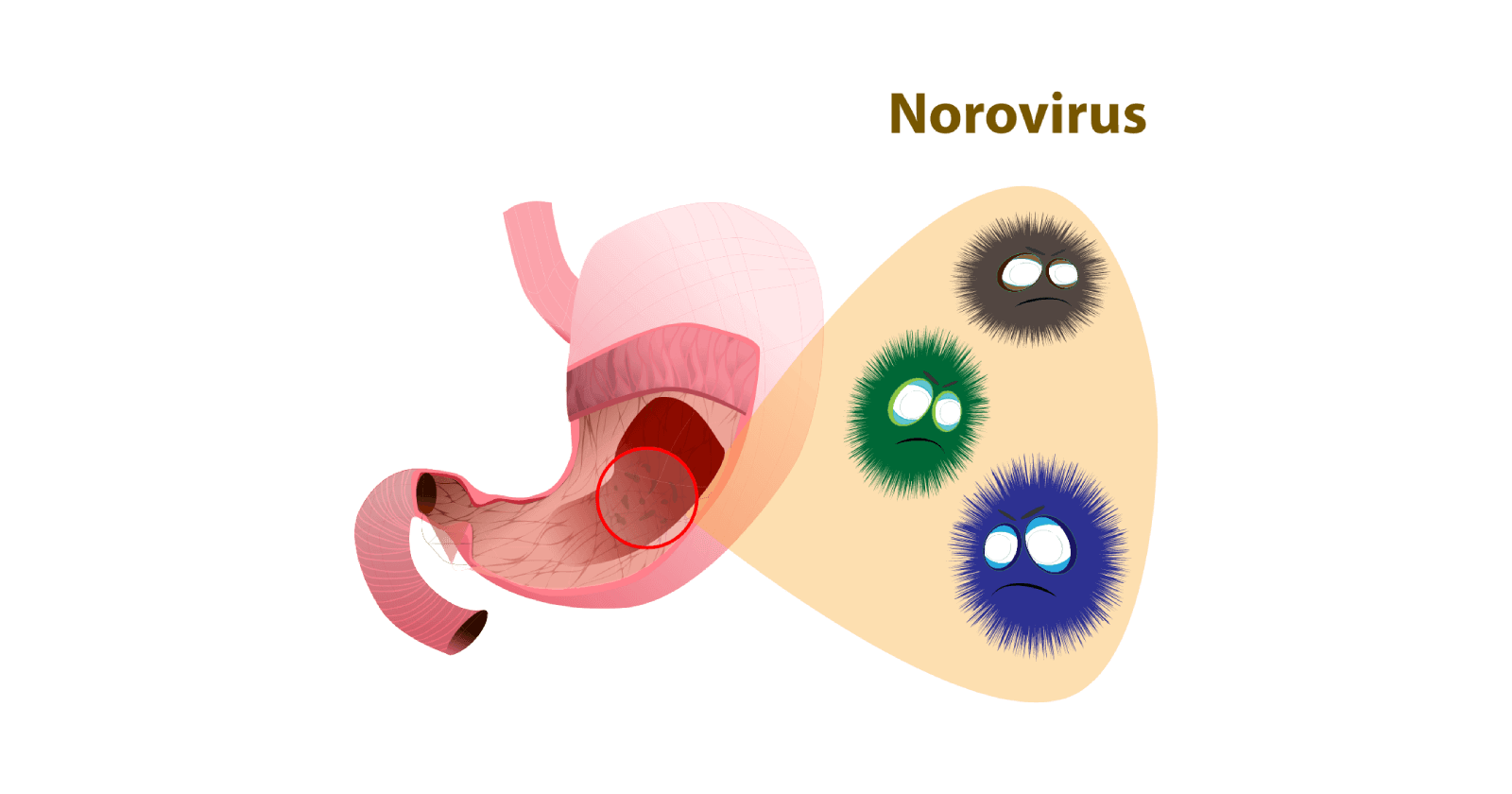 Norovirus Symptoms, Causes, Prevention and Treatments