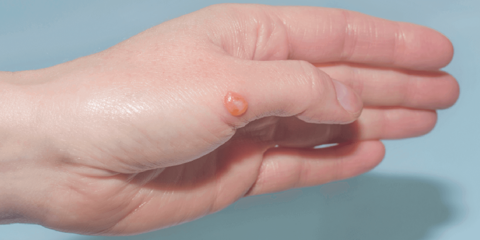 First Aid Guide: Dealing with Blisters
