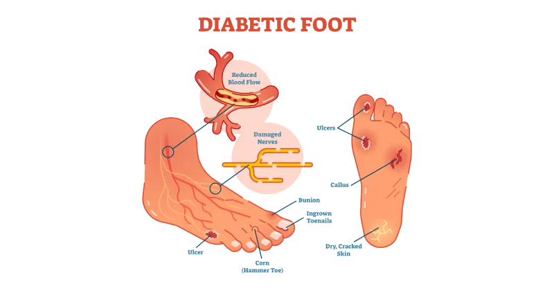 Diabetic Foot