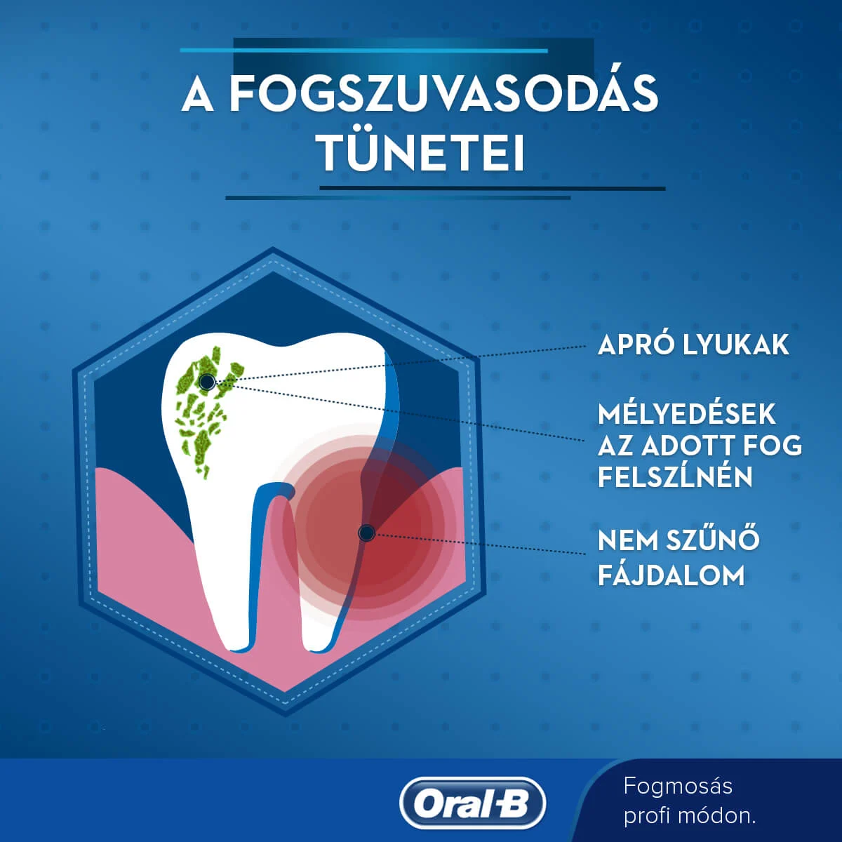 Mit a fogszuvasodás? Kezelése, jelei és tünetei 