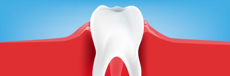 A fogínygyulladás (gingivitis) tünetei, okai és kezelése