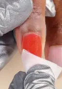 Cleanse nails with a nail wipe saturated with N.A.S. 99 Cleansing Solution