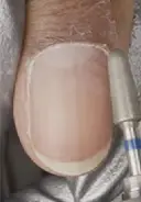 Change the bit to a medium grit diamond and guide the bit from one side of the nail to the other