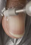 Turn the finger, and pulling back the lateral fold, guide the bit down the sidewall of the nail