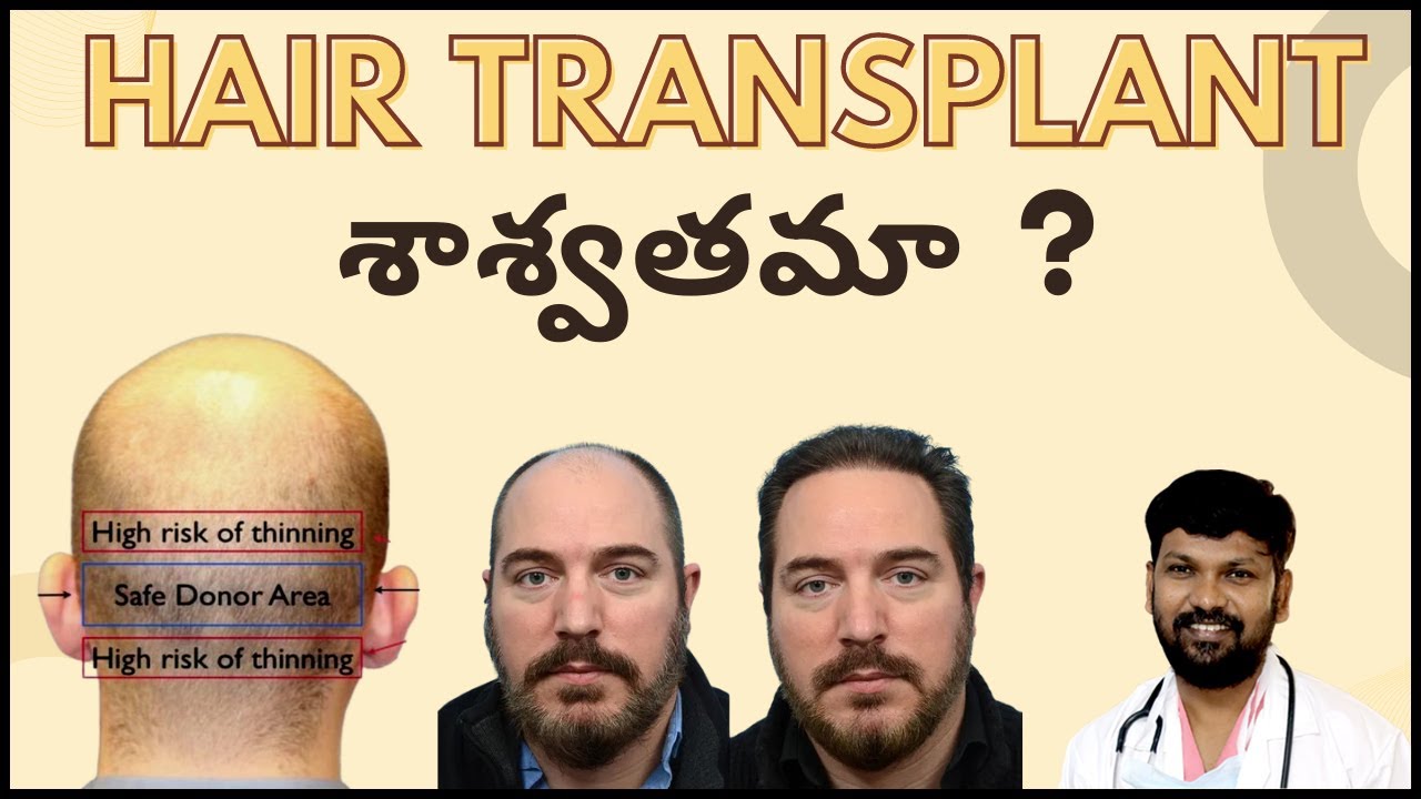 Does Hair Transplant Results Stay Permanent or Temporary? 