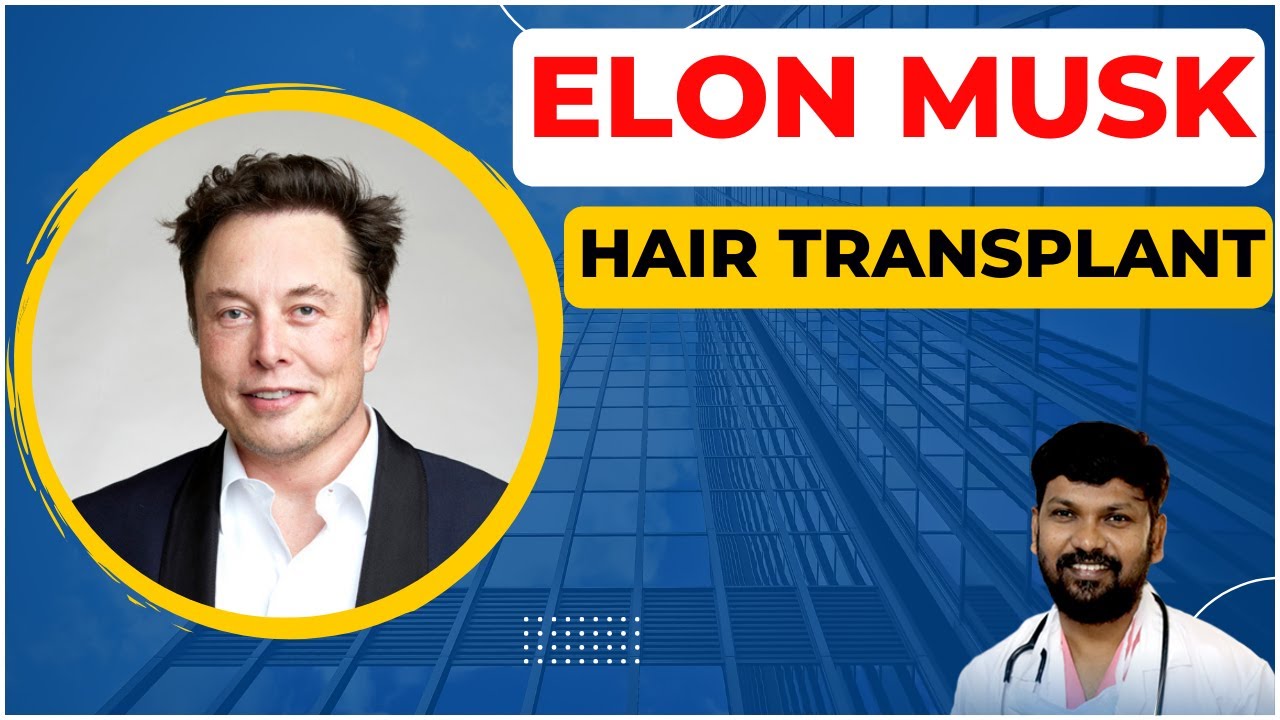 Did Elon Musk Undergo a Hair Transplant?
