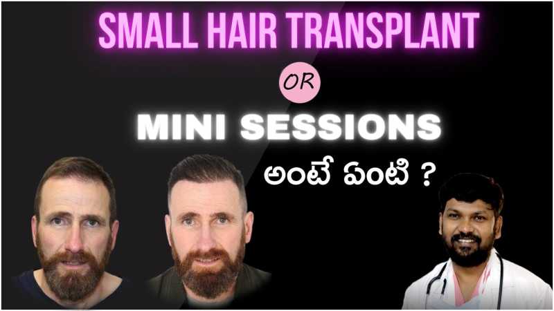 What is Small Hair Transplant?