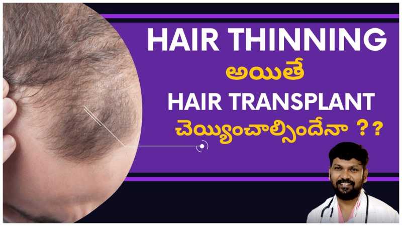 Is Medical Treatment OK for Hair Thinning or Will it Lead to Baldness?