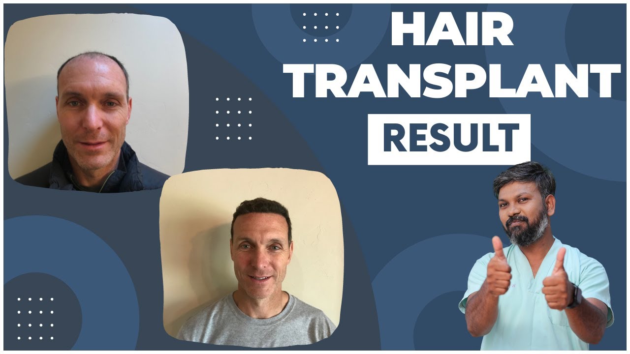 Should You Worry If You Don't Notice Hair Growth Two Months After a Hair Transplant?