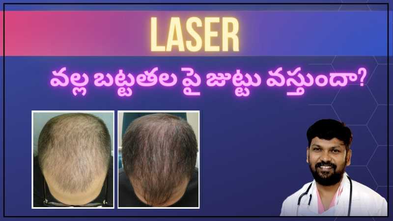 Low-Level Laser Treatment for Hair Loss