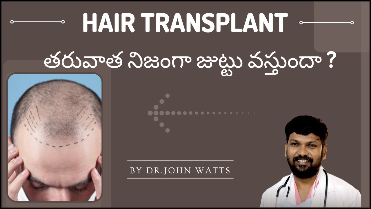 Is Hair Transplant Really Effective?