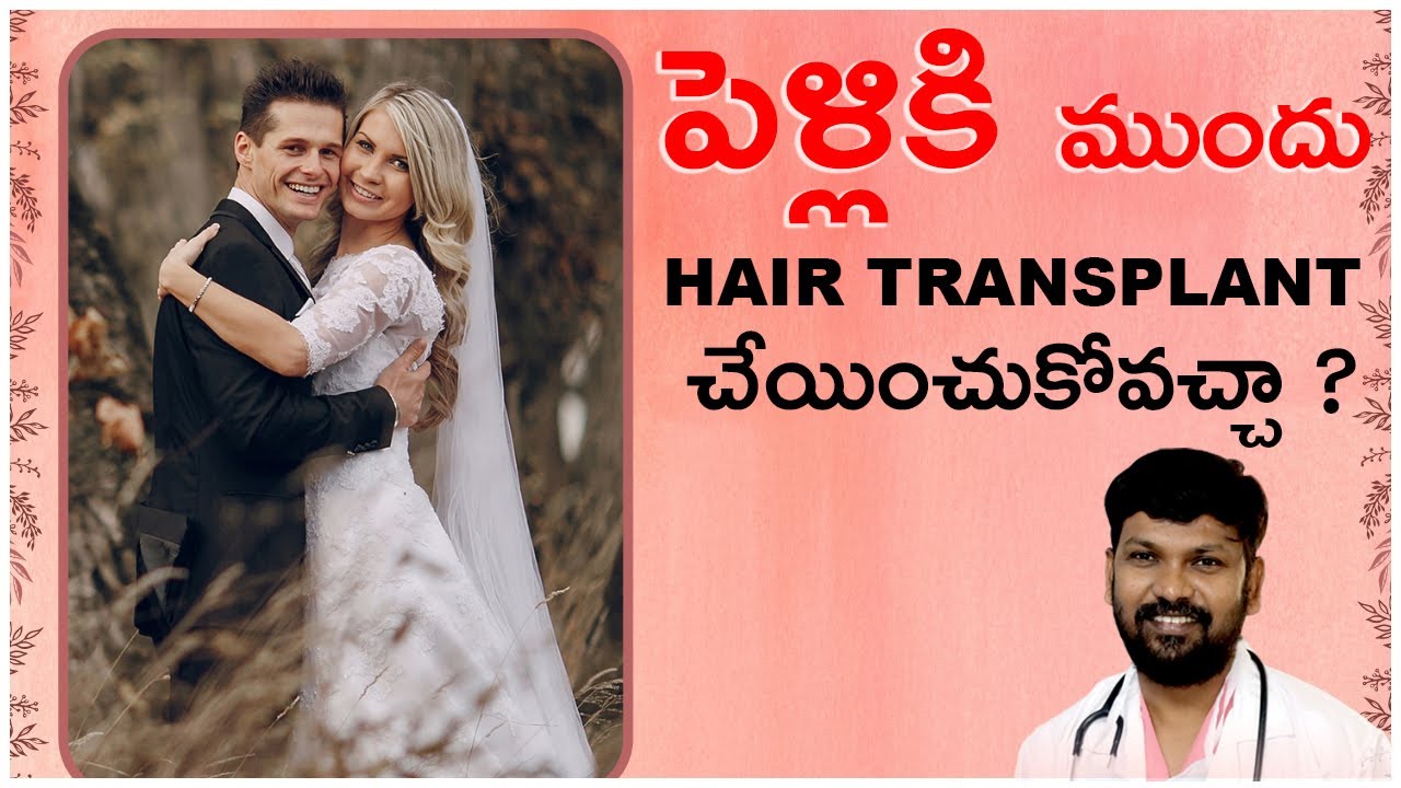 What’s the Ideal Time to Undertake Hair Transplant Before Marriage?