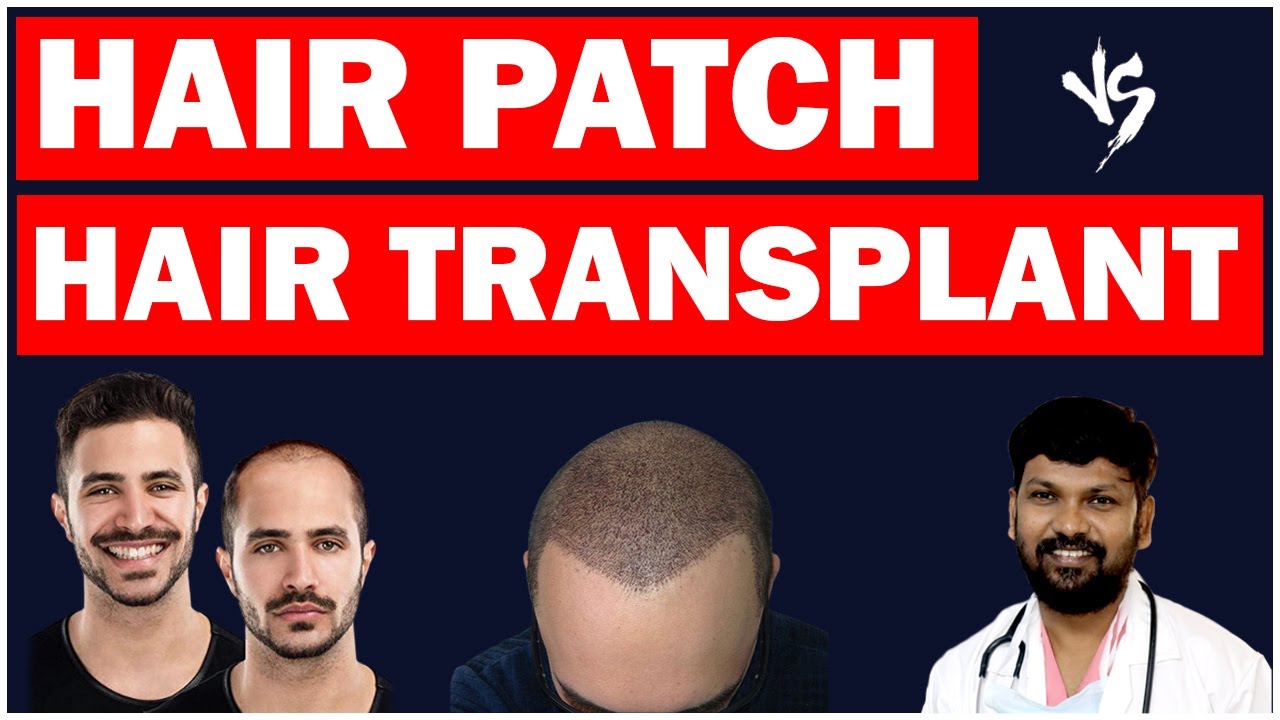 Hair Transplant Vs Hair Patch: Which is Better?