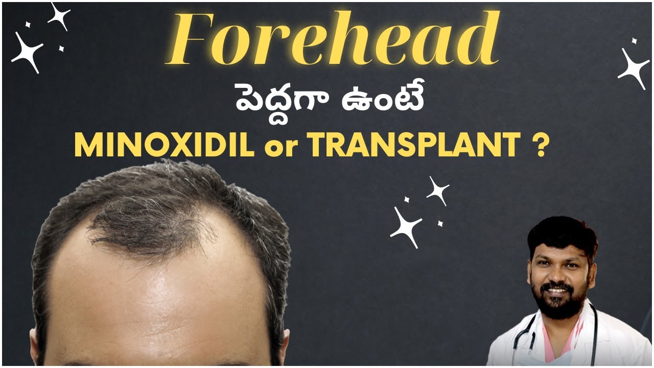 If forehead looks too wide, Minoxidil or hair transplant?
