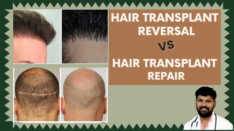 Difference Between Hair Transplant Reversal & Hair Transplant Repair