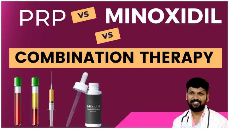 In Early Stage of Baldness, Is Only PRP/Minoxidil Enough or Both Needed?
