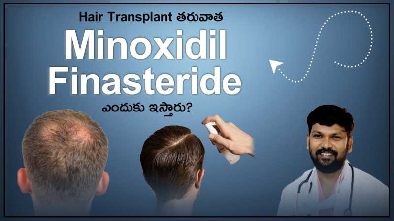 Why Minoxidil & Finasteride Advised Post Hair Transplant