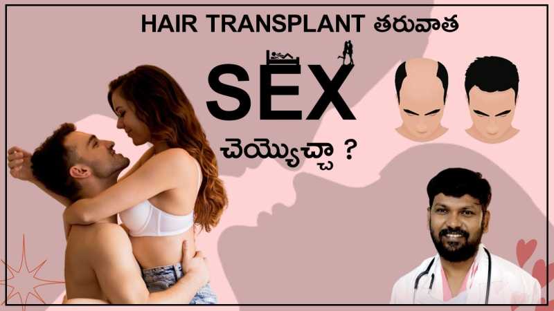 Sex After a Hair Transplant