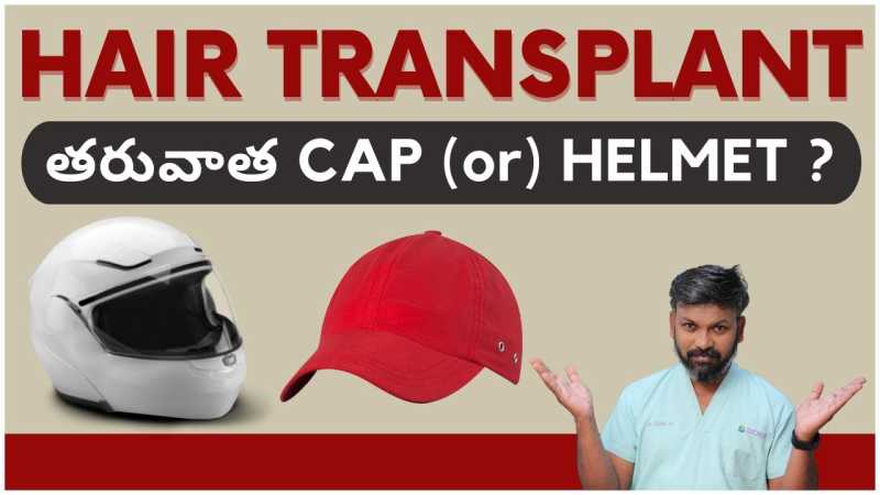 When Can You Wear Helmets or Caps After a Hair Transplant?