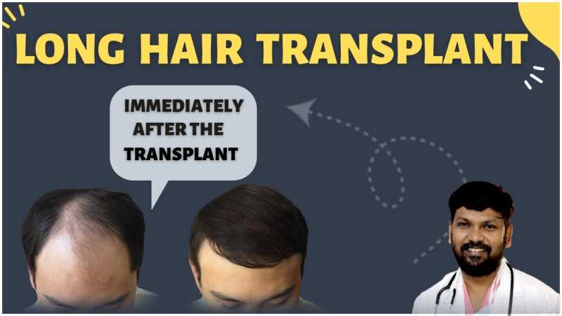 Is Long Hair Transplantation Better? 