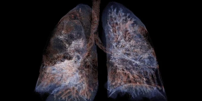 Project BreathEasy生成的人类肺部数字孪生体的3D 仿真模型之一。