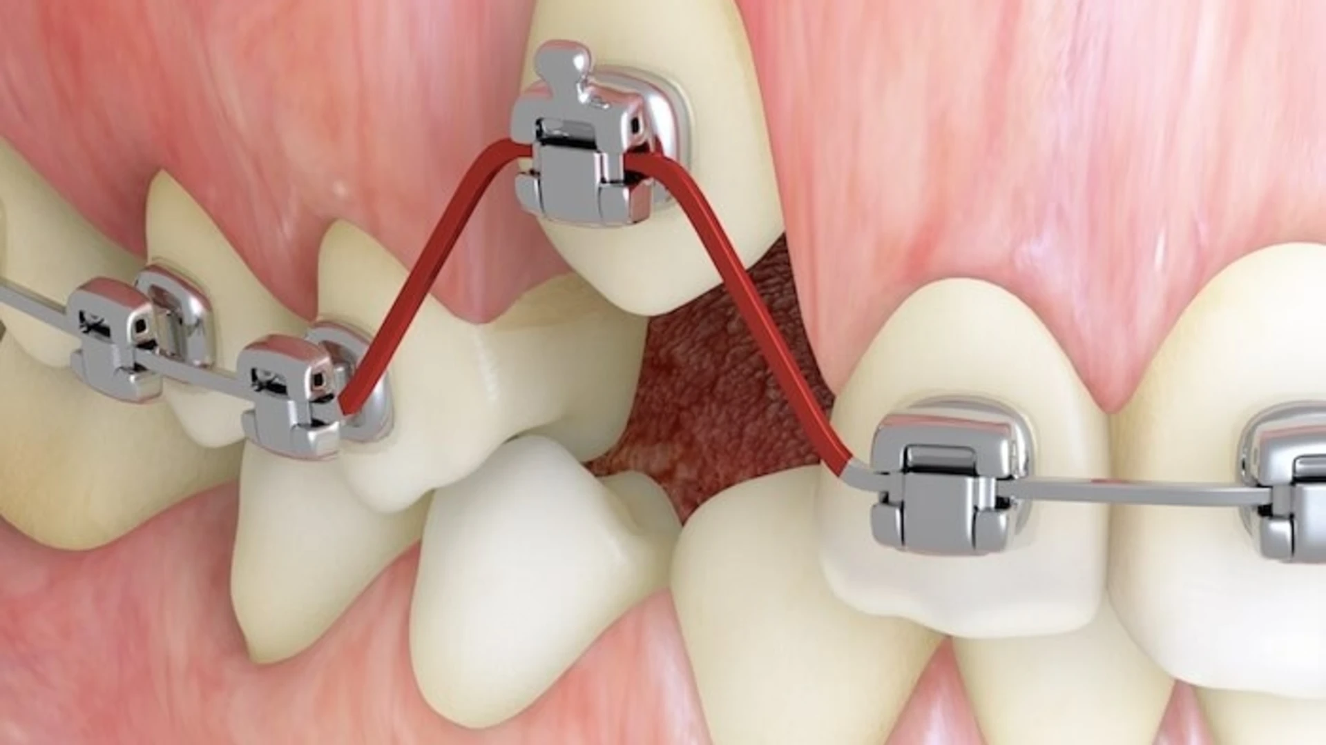 Shape-memory alloys bid adieu to old-school orthodontics