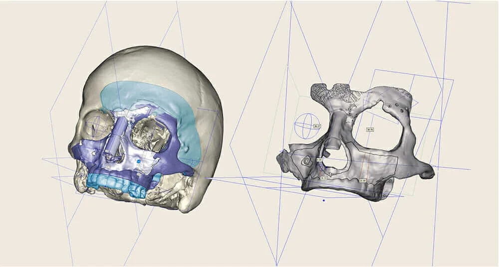 3d-printed titanium CEIT cranial implant scan