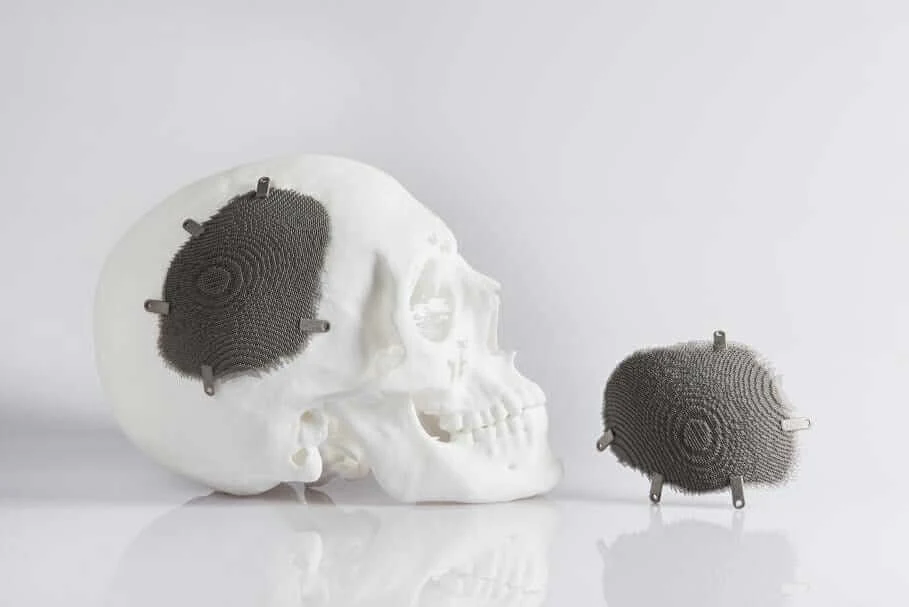 3d-printed titanium Novax DMA cranial implant