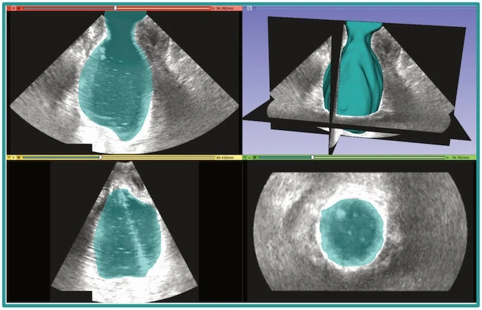Four pelvic ultrasound images in a grid formation