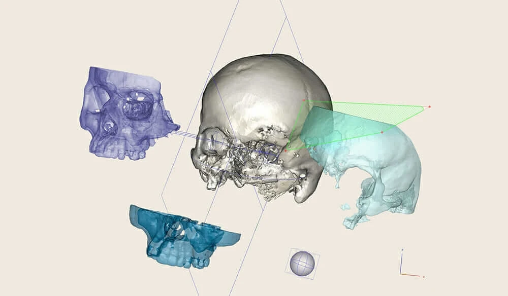 3d-printed titanium CEIT cranial implant
