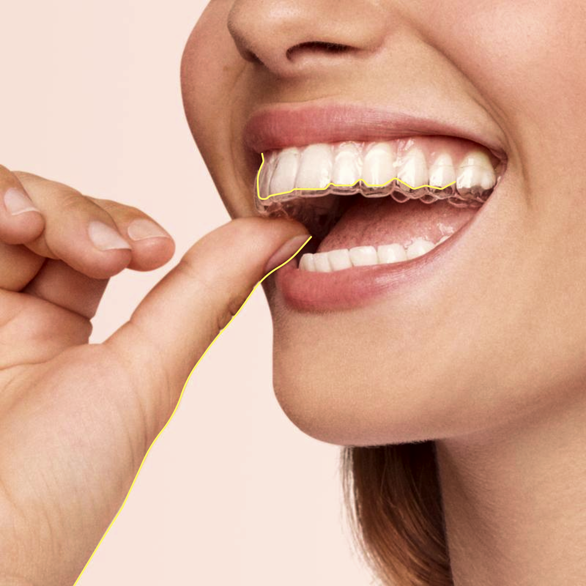 Eine Frau lächelt und zeigt gerade Zähne, in einer Hand hält sie eine durchsichtige Zahnschiene