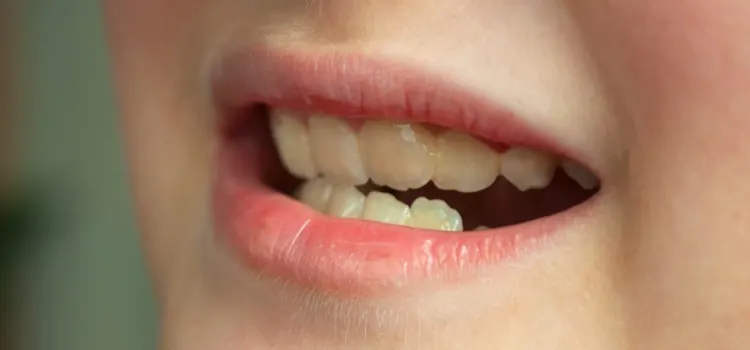 Primo piano su bocca di un bambino che stringe i denti, evidenza dei denti da ciuccio