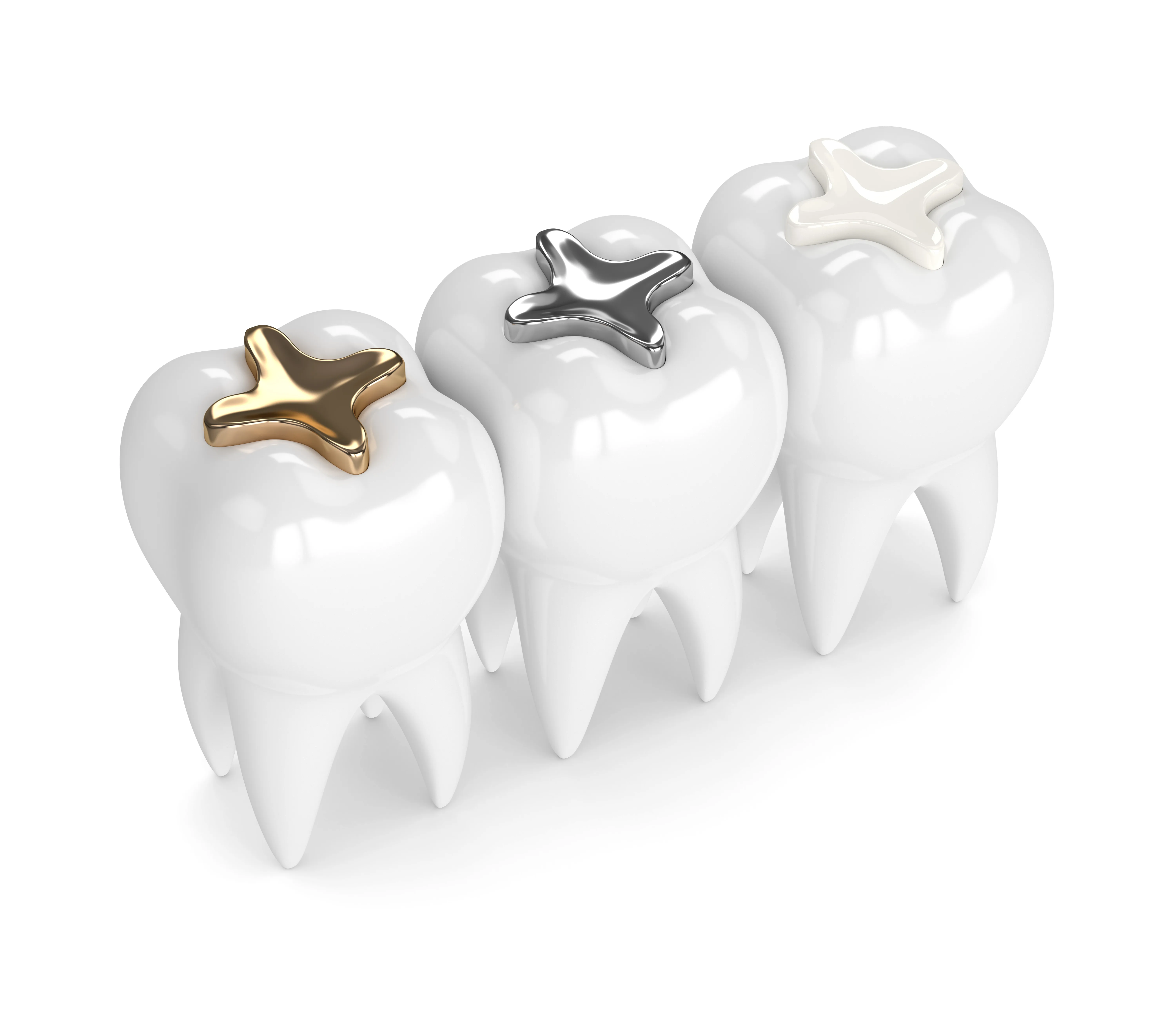 Diversi tipi di otturazioni dentali