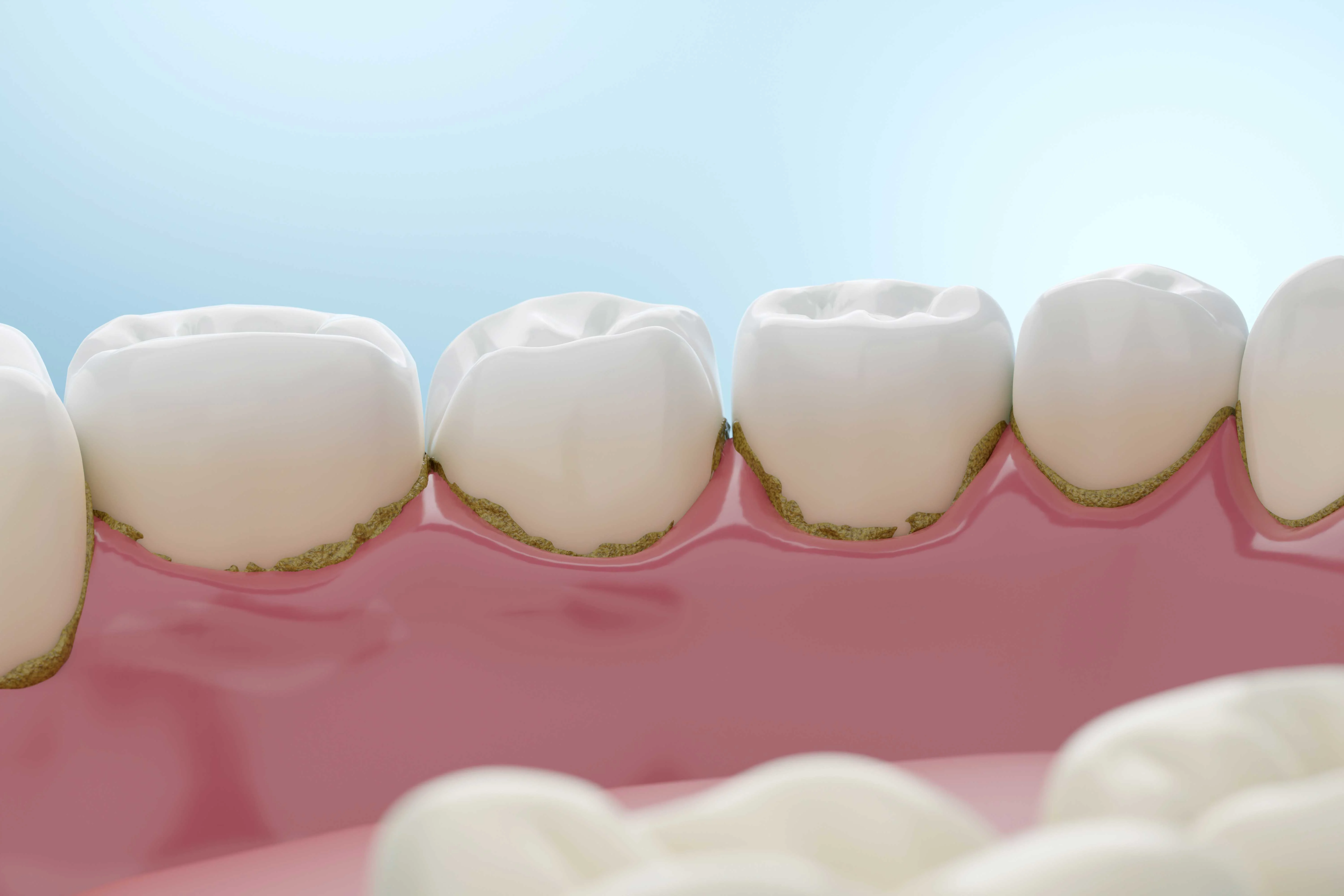 Article - Plaque (Dental Plaque): Causes, Prevention, and Removal - Placca (placca dentale): Cause, prevenzione e rimozione - HERO_