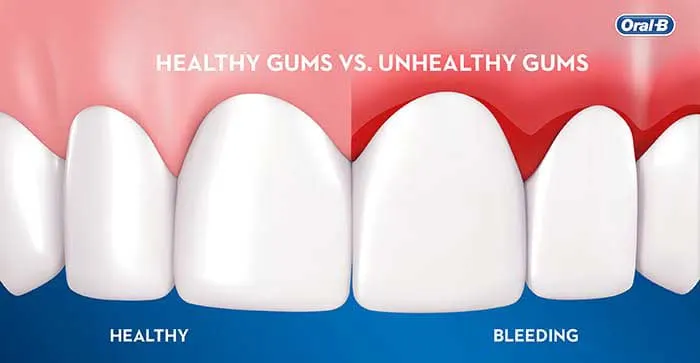 Article - Bleeding Gums: Causes, Symptoms, and Treatments - Gengive sanguinanti: Cause, sintomi e trattamenti - HERO