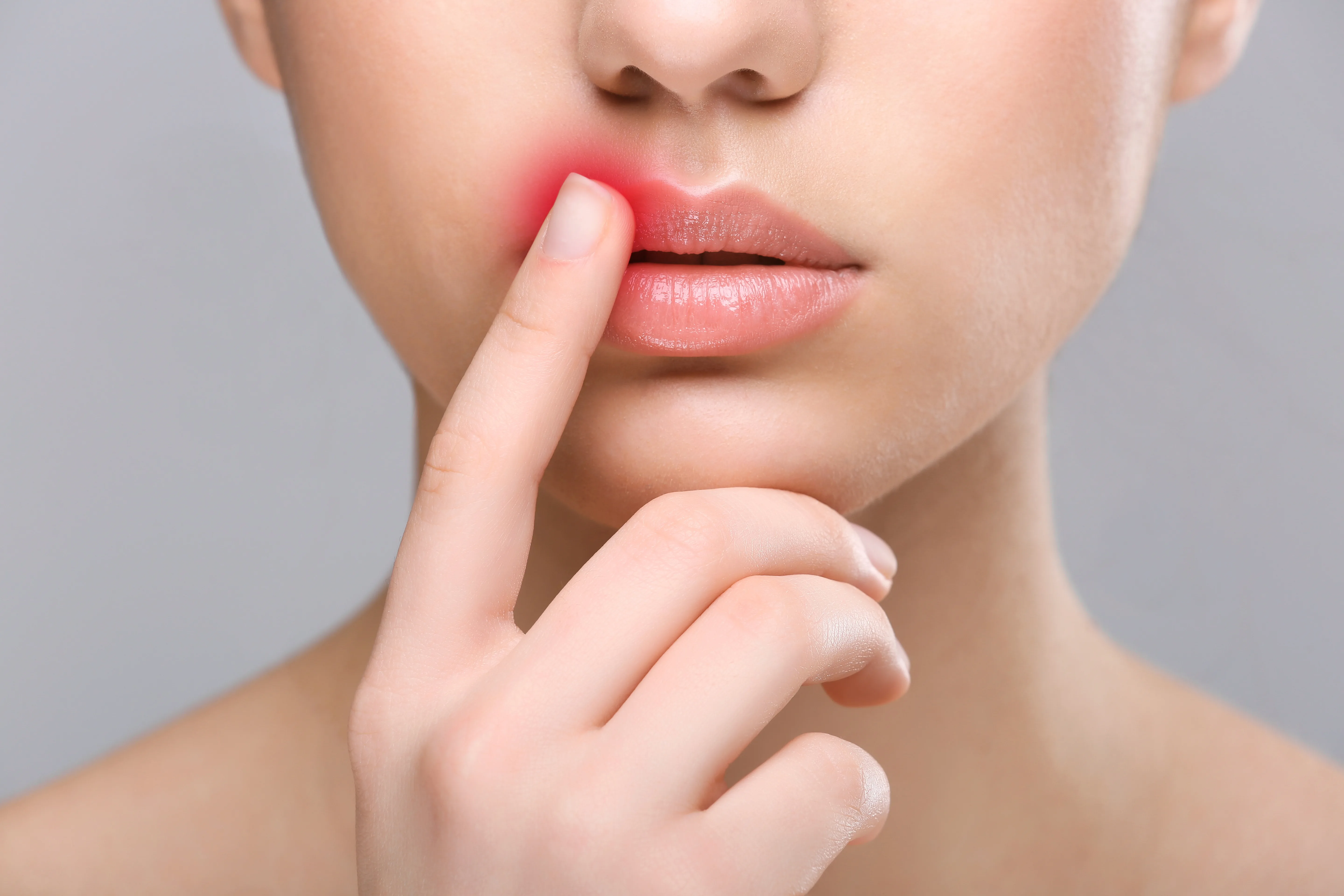Herpes labiale sul labbro della donna