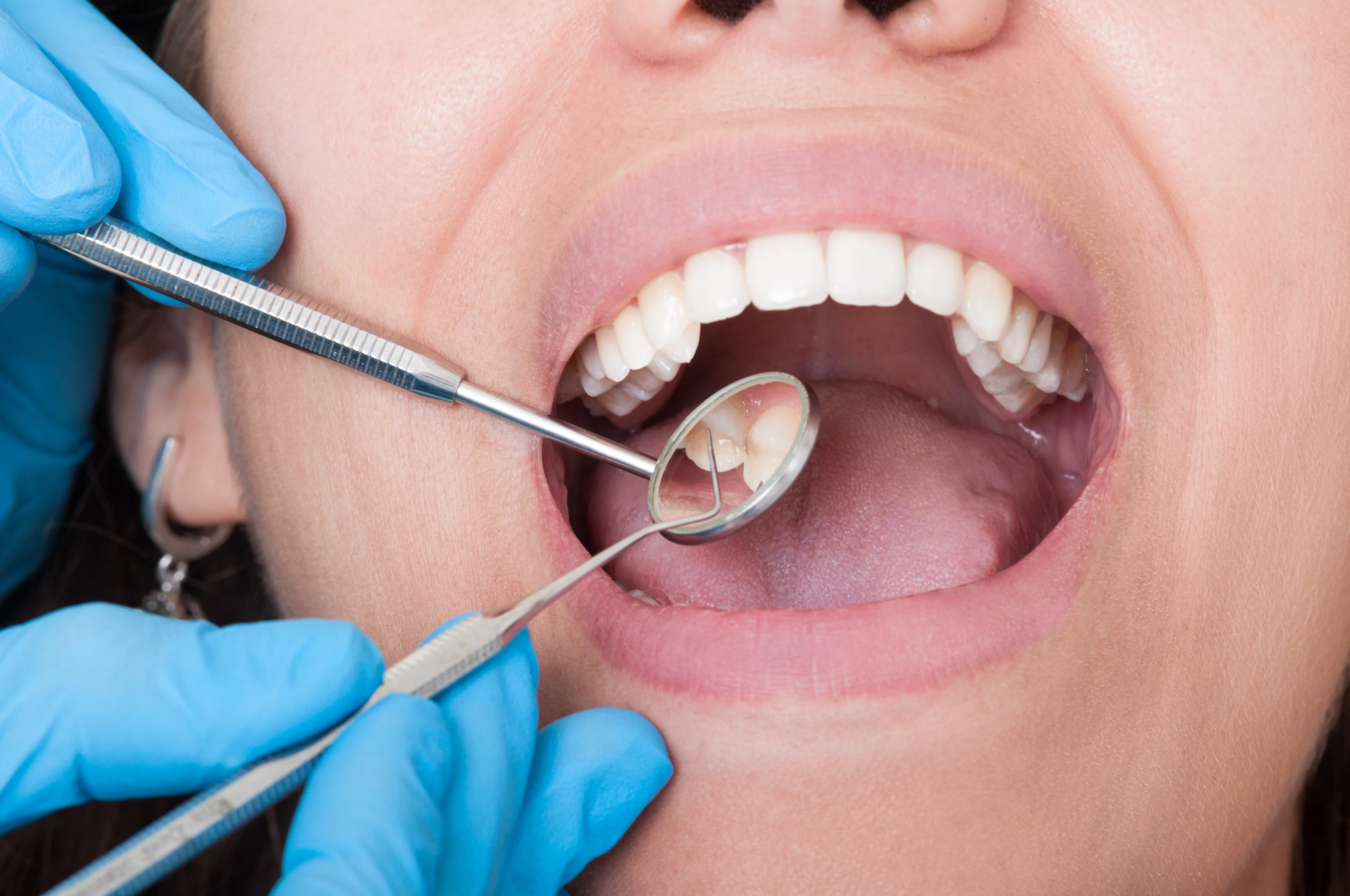 Paziente odontoiatrico con bocca aperta e dentista che valuta l'interno della bocca