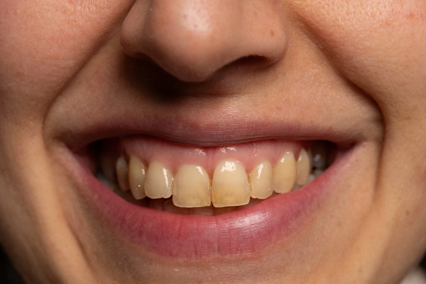 Image - Article - Ipoplasia dello smalto: come prevenire uno smalto dentale debole?