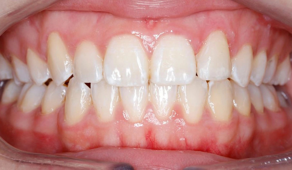 Extraction tooth case after Invisalign® treatment