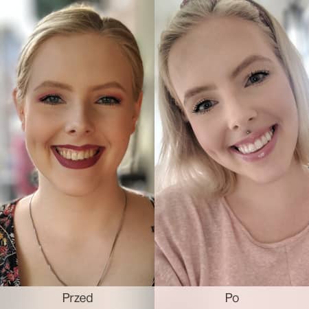 Before and after wearing Invisalign aligners