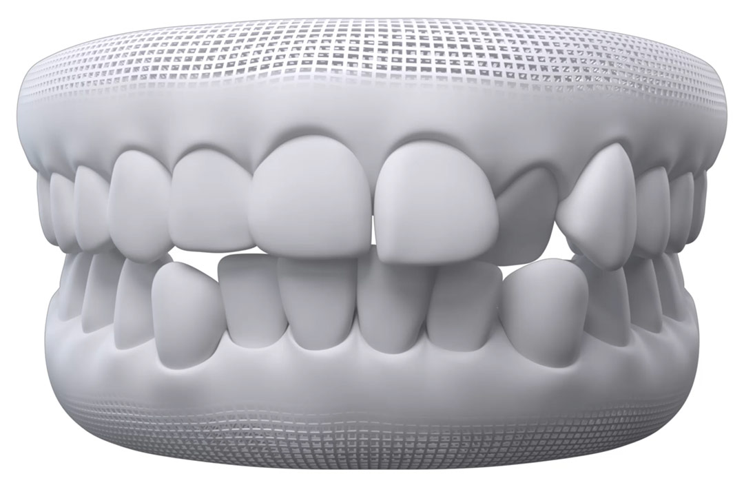 Invisalign – Clips Odontologia