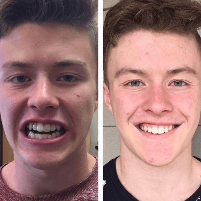 Before and after image of Invisalign Treatment