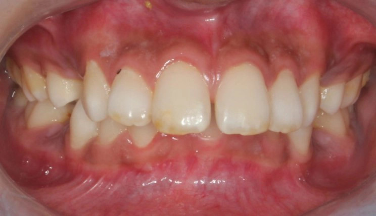 Deep bite tooth case before Invisalign® treatment