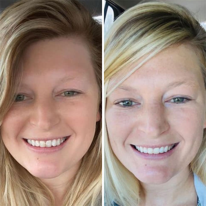 Coût d’Invisalign | Quel est le coût du traitement Invisalign