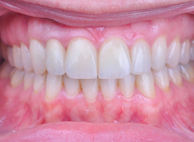 Prosthodontic Dentistry Implant placement third case