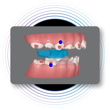 Innovation | Treat | Mandibural Advancement Occlusal Blocks over Eruption Compensation [NEW]