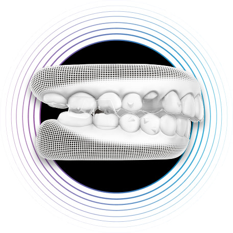 Innovation | Treat | Mandibural Advancement Occlusal Blocks over Eruption Compensation [NEW]